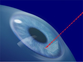 IntraLase All-Laser No-Blade LASIK Surgery Flap Creation